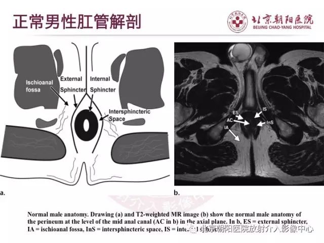 【PPT】肛瘘相关MRI影像学解剖及诊断