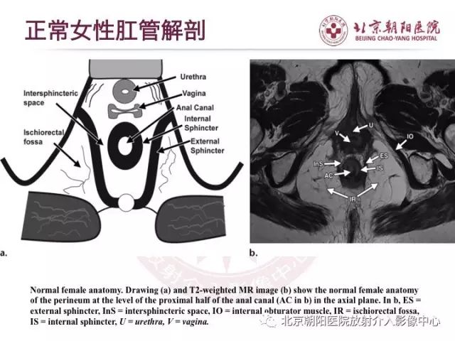 【PPT】肛瘘相关MRI影像学解剖及诊断