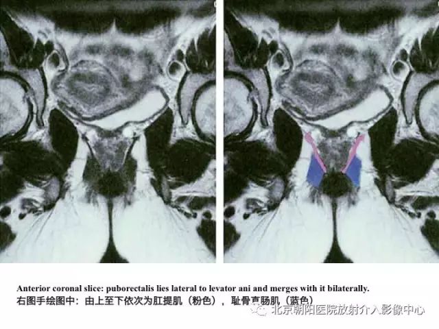 【PPT】肛瘘相关MRI影像学解剖及诊断