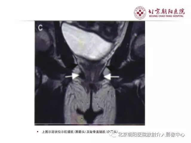 【PPT】肛瘘相关MRI影像学解剖及诊断