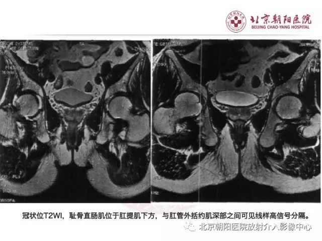 【PPT】肛瘘相关MRI影像学解剖及诊断