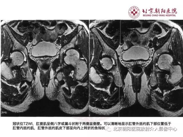 【PPT】肛瘘相关MRI影像学解剖及诊断