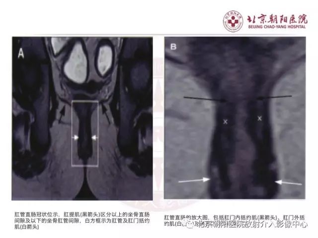 【PPT】肛瘘相关MRI影像学解剖及诊断