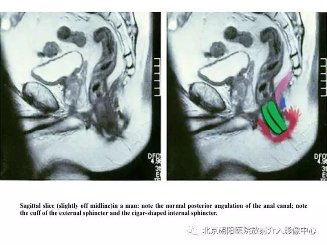 【PPT】肛瘘相关MRI影像学解剖及诊断