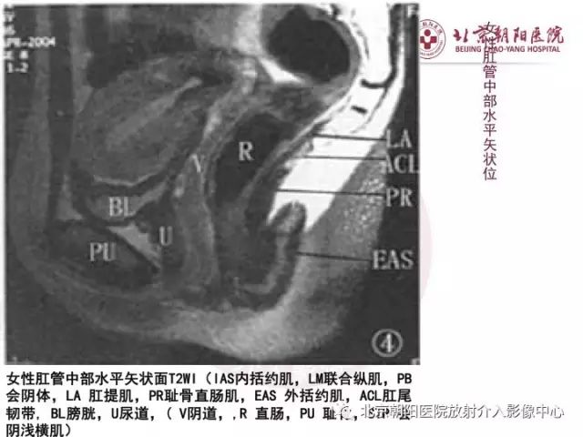 【PPT】肛瘘相关MRI影像学解剖及诊断