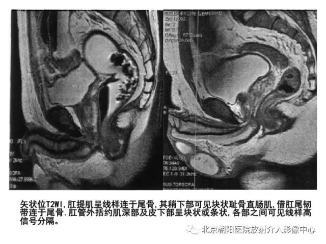 【PPT】肛瘘相关MRI影像学解剖及诊断