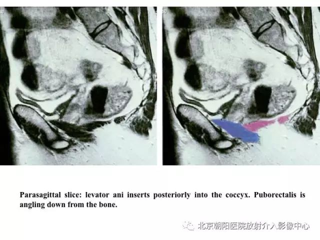 【PPT】肛瘘相关MRI影像学解剖及诊断