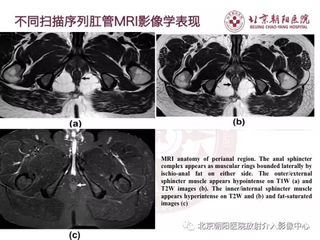 【PPT】肛瘘相关MRI影像学解剖及诊断