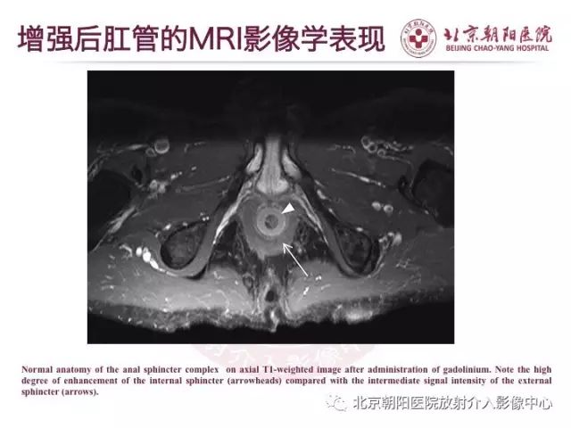 【PPT】肛瘘相关MRI影像学解剖及诊断