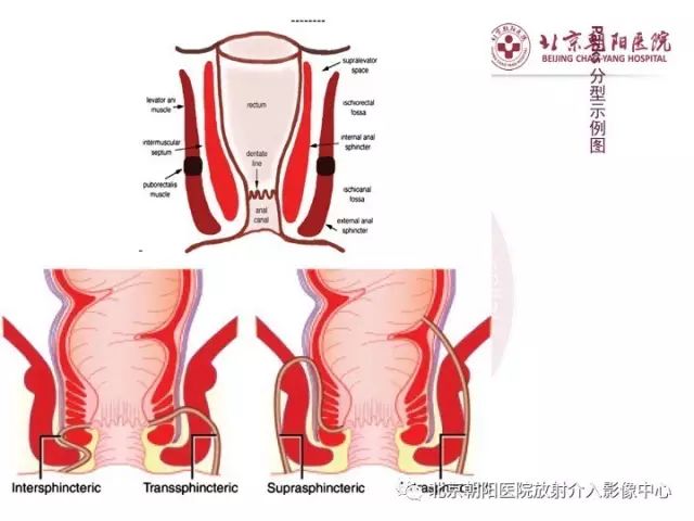 【PPT】肛瘘相关MRI影像学解剖及诊断