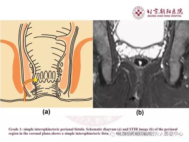 【PPT】肛瘘相关MRI影像学解剖及诊断