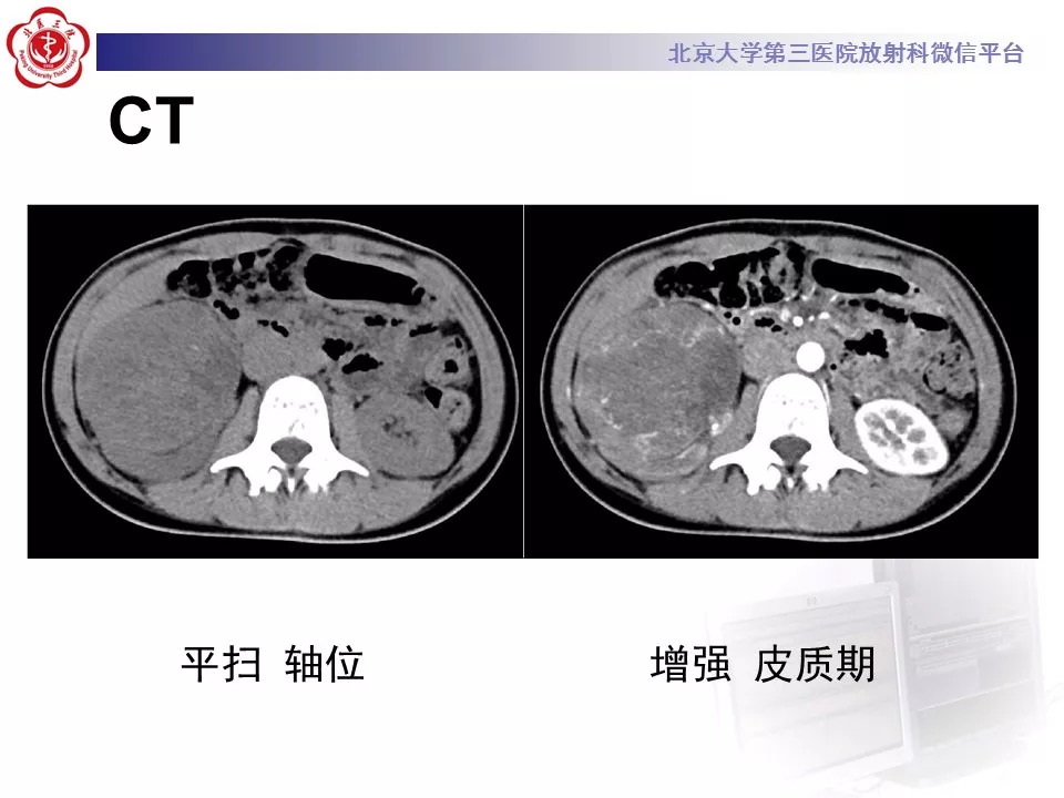【病例】肾脏尤文氏肉瘤/原始神经外胚层肿瘤1例CT