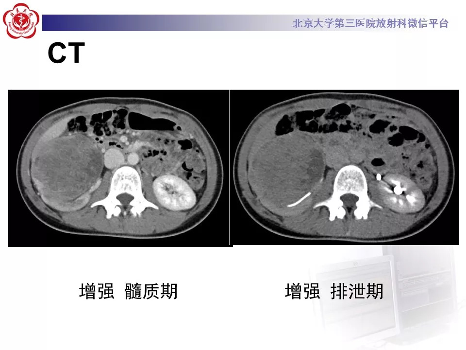 【病例】肾脏尤文氏肉瘤/原始神经外胚层肿瘤1例CT