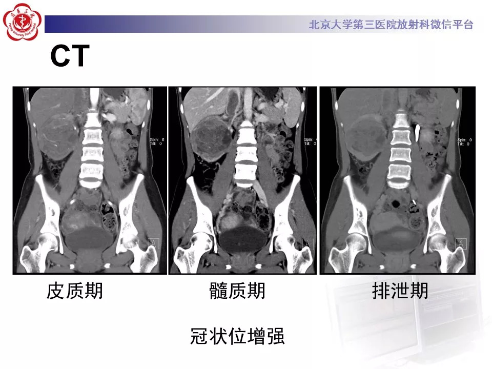 【病例】肾脏尤文氏肉瘤/原始神经外胚层肿瘤1例CT