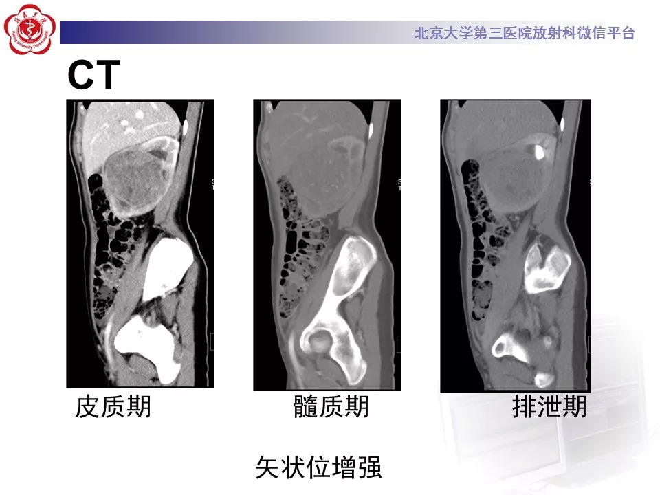 【病例】肾脏尤文氏肉瘤/原始神经外胚层肿瘤1例CT