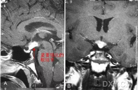 中枢神经系统结节病的诊断和鉴别诊断 中枢神经系统结节病的诊断和鉴别诊断
