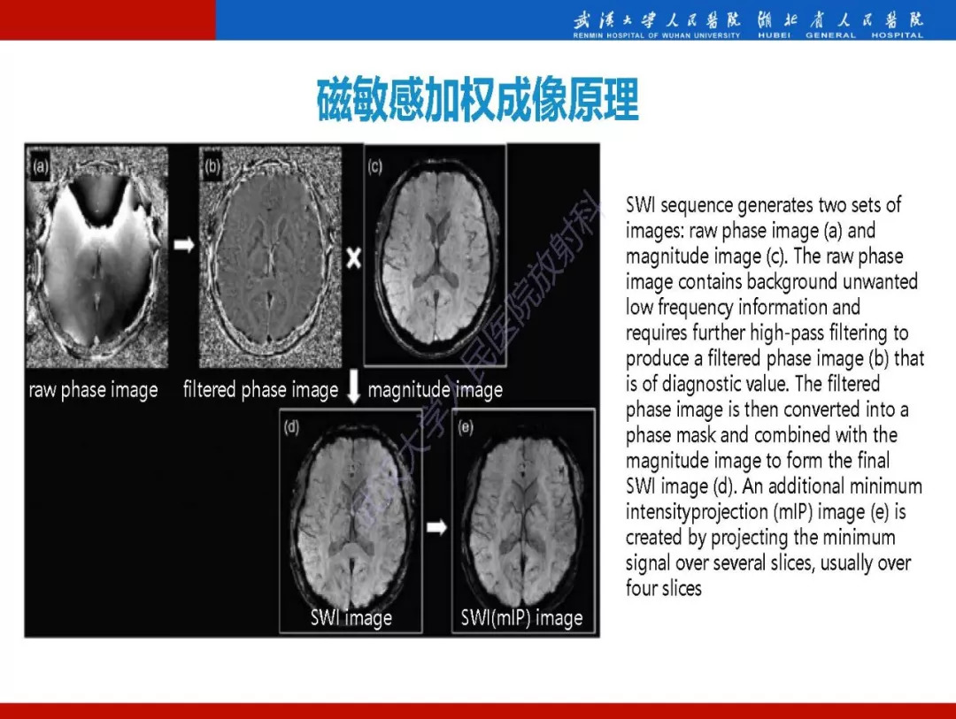 【PPT】磁敏感加权成像原理及临床应用