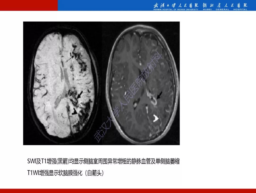 【PPT】磁敏感加权成像原理及临床应用