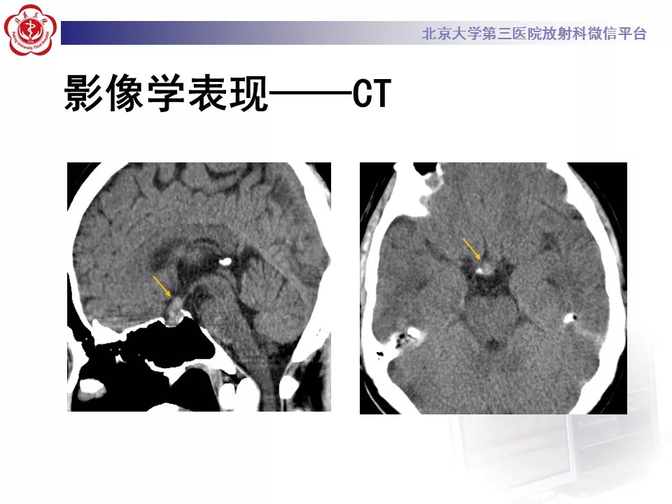 【病例】鞍区生殖细胞瘤1例CT及MR
