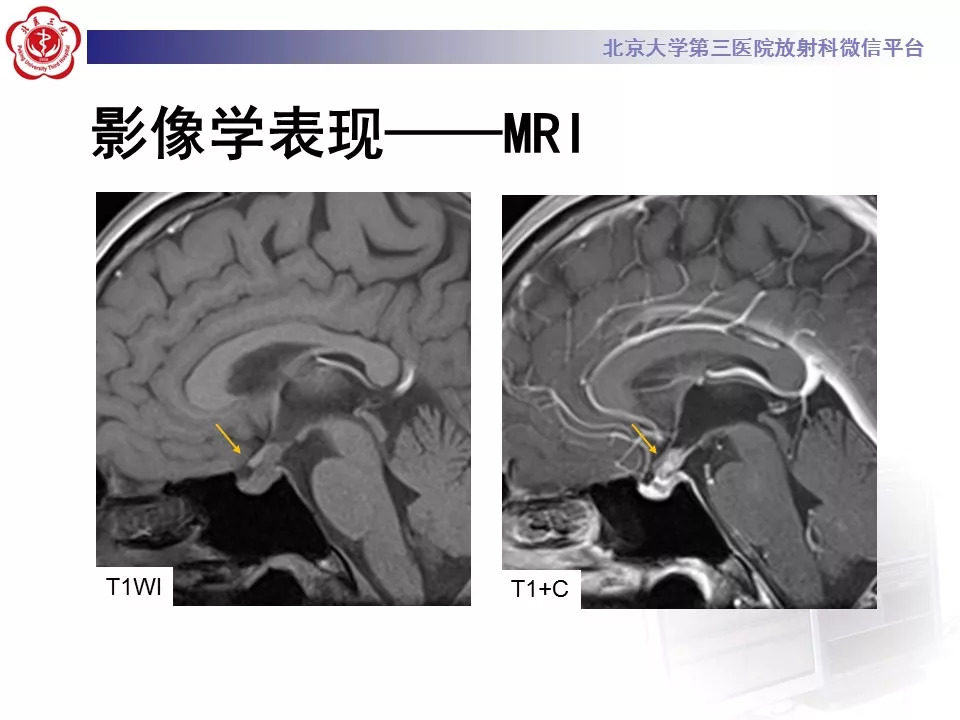 【病例】鞍区生殖细胞瘤1例CT及MR