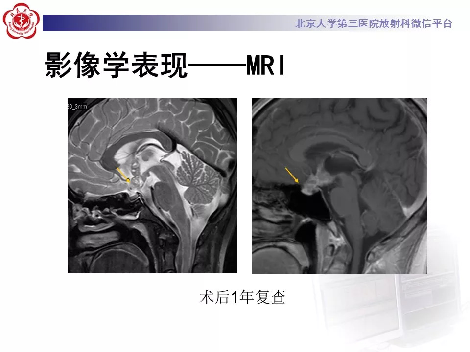 【病例】鞍区生殖细胞瘤1例CT及MR
