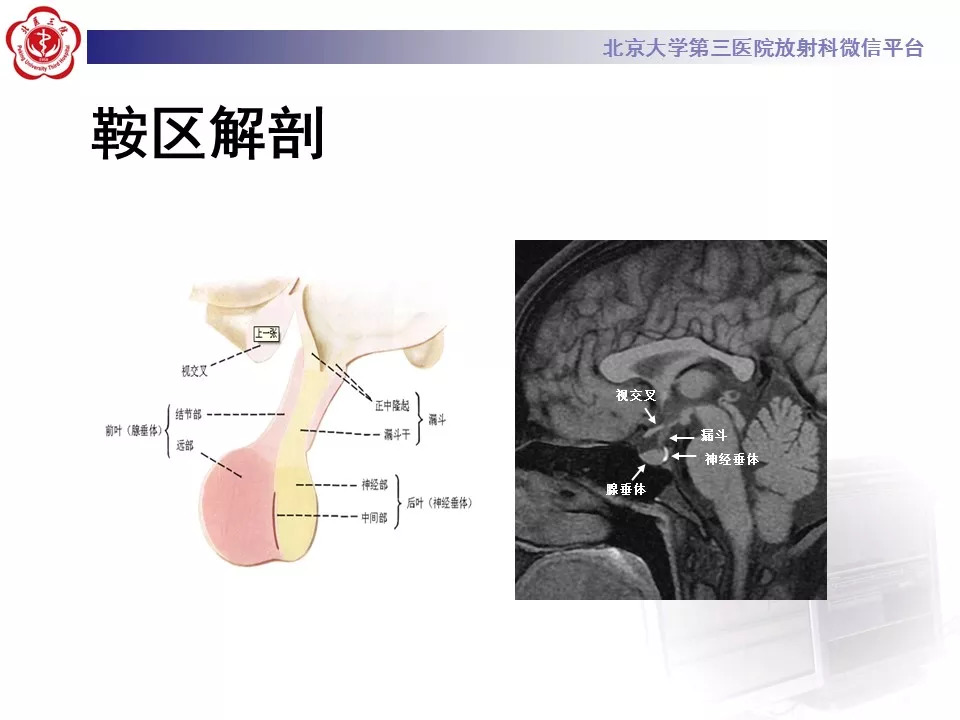【病例】鞍区生殖细胞瘤1例CT及MR