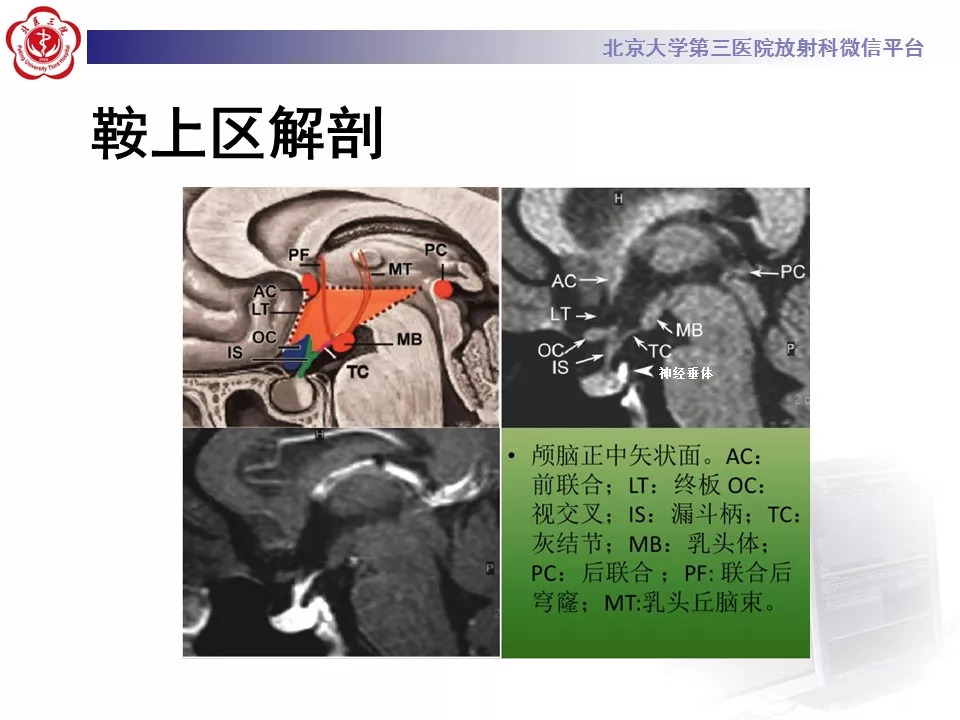 【病例】鞍区生殖细胞瘤1例CT及MR