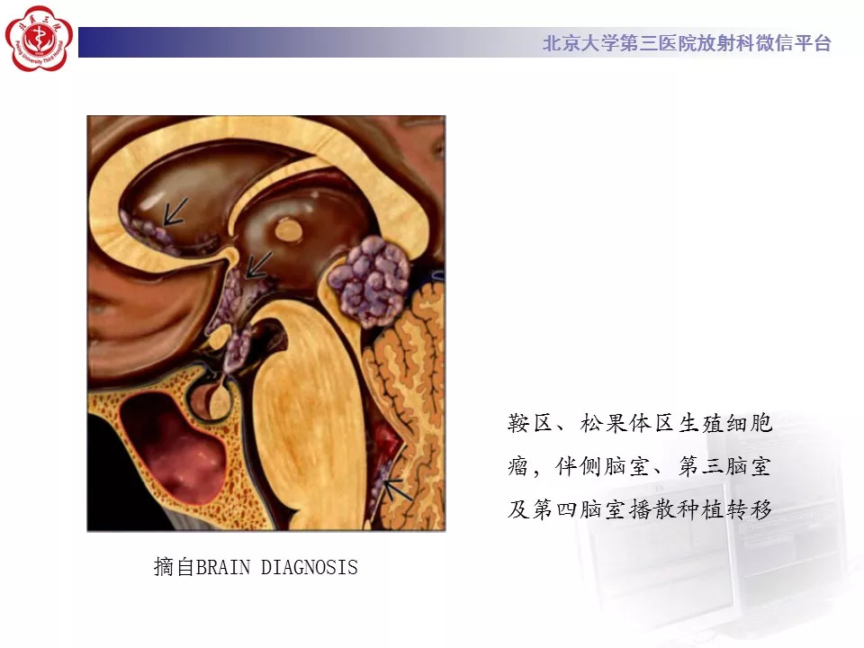 【病例】鞍区生殖细胞瘤1例CT及MR