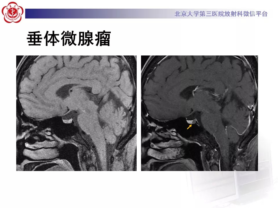 【病例】鞍区生殖细胞瘤1例CT及MR