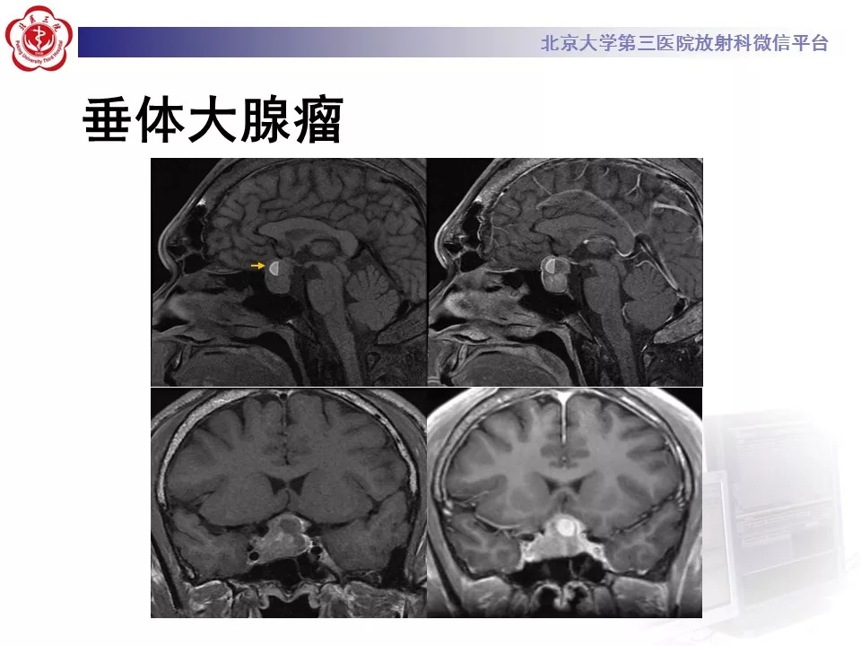 【病例】鞍区生殖细胞瘤1例CT及MR