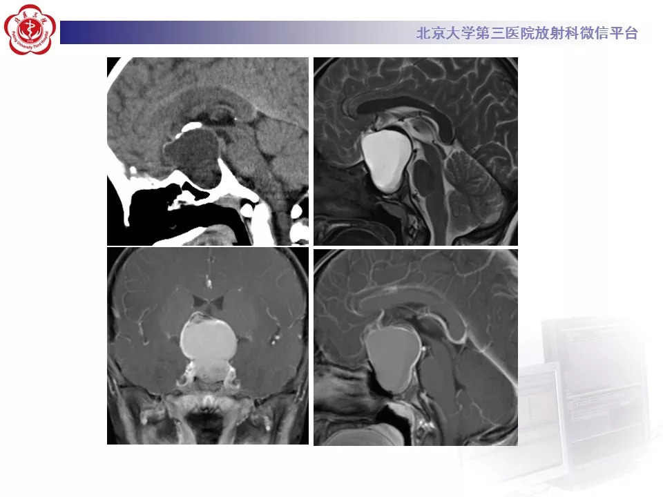 【病例】鞍区生殖细胞瘤1例CT及MR
