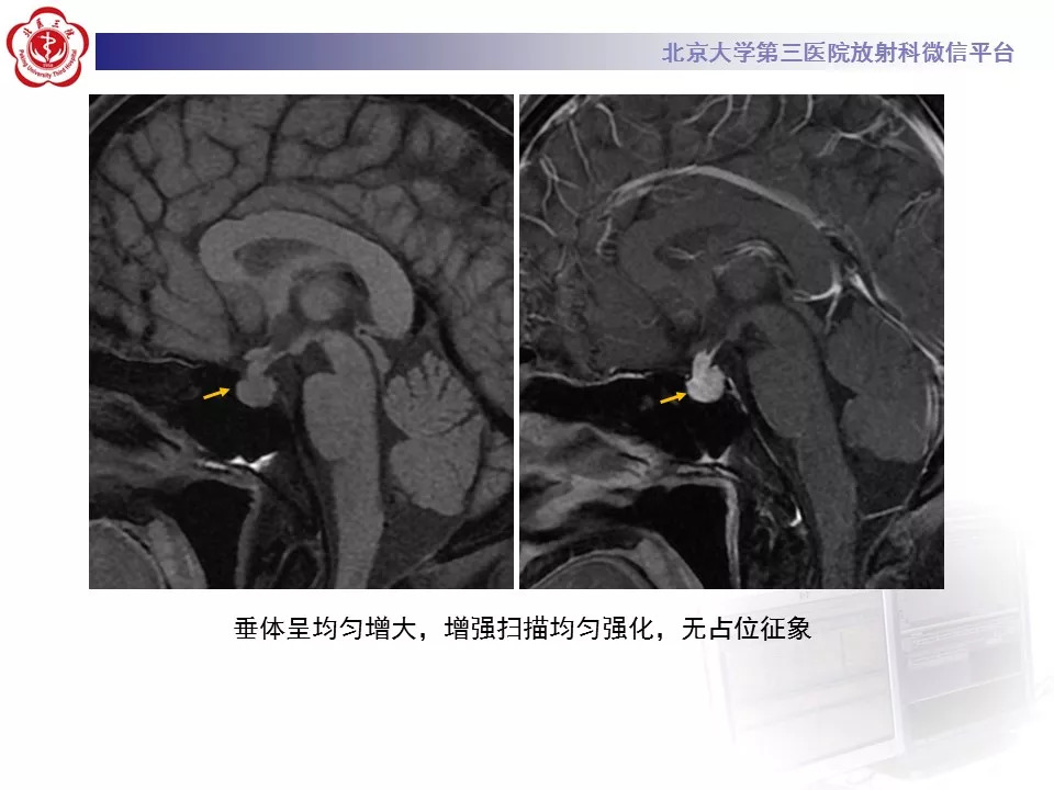 【病例】鞍区生殖细胞瘤1例CT及MR