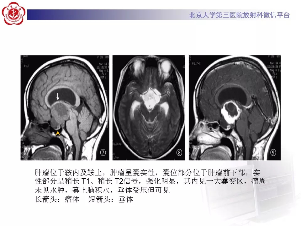 【病例】鞍区生殖细胞瘤1例CT及MR