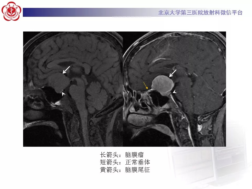 【病例】鞍区生殖细胞瘤1例CT及MR