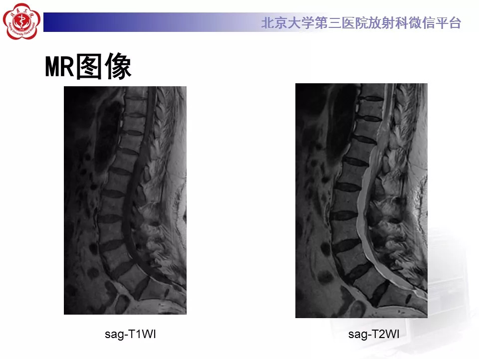 【病例】椎管内硬膜外血管脂肪瘤1例MR
