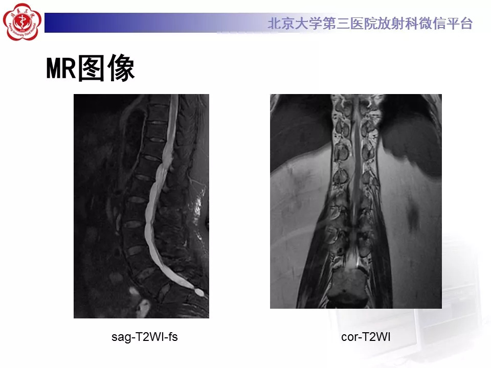 【病例】椎管内硬膜外血管脂肪瘤1例MR