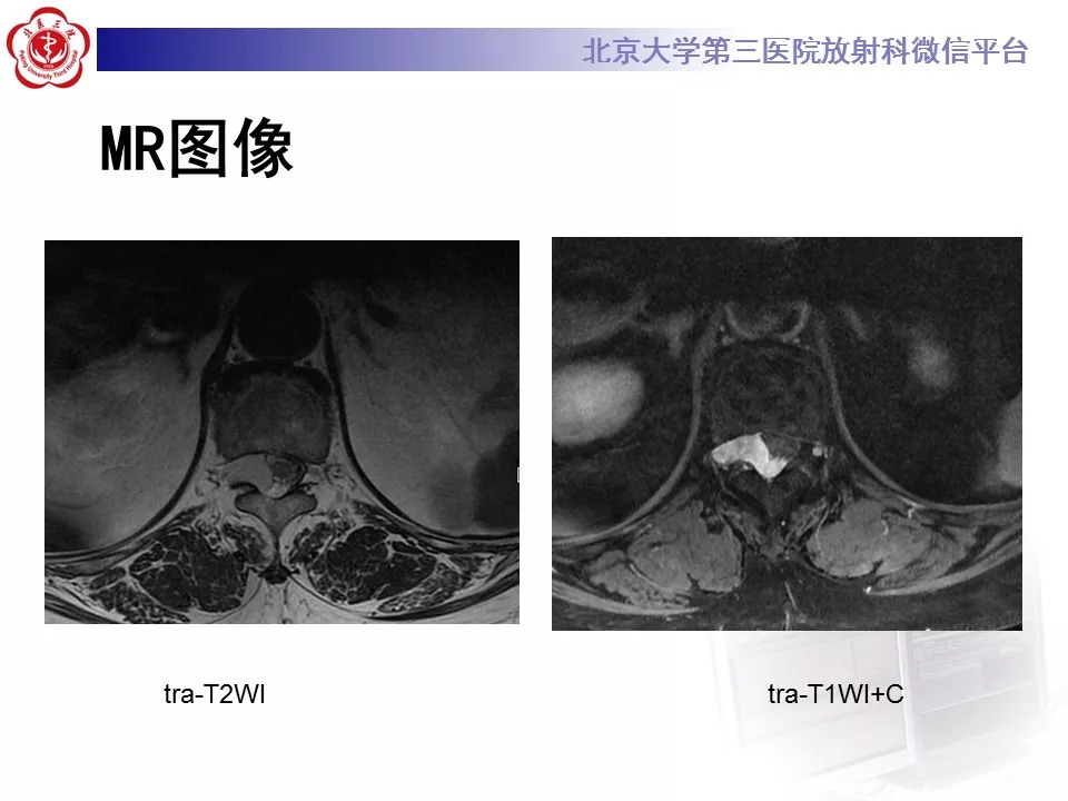 【病例】椎管内硬膜外血管脂肪瘤1例MR