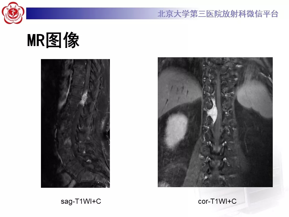 【病例】椎管内硬膜外血管脂肪瘤1例MR