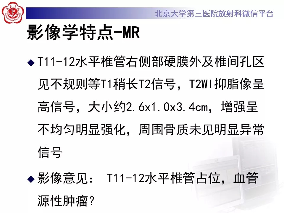 【病例】椎管内硬膜外血管脂肪瘤1例MR