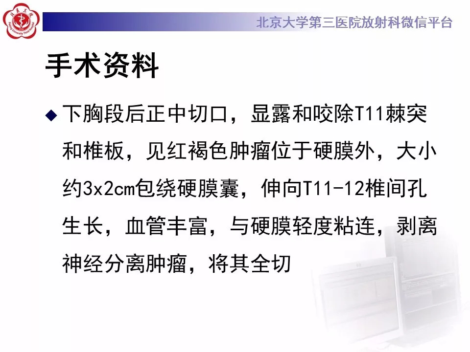 【病例】椎管内硬膜外血管脂肪瘤1例MR