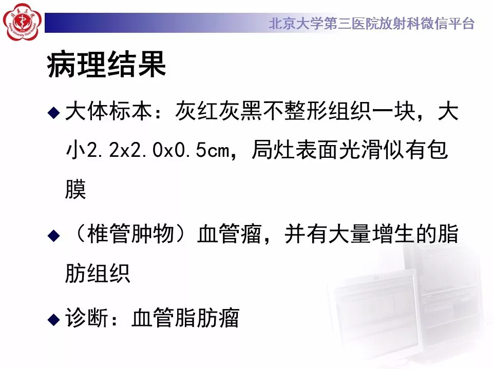 【病例】椎管内硬膜外血管脂肪瘤1例MR