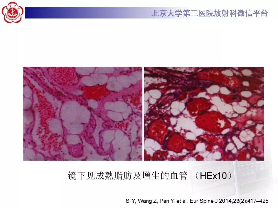 【病例】椎管内硬膜外血管脂肪瘤1例MR