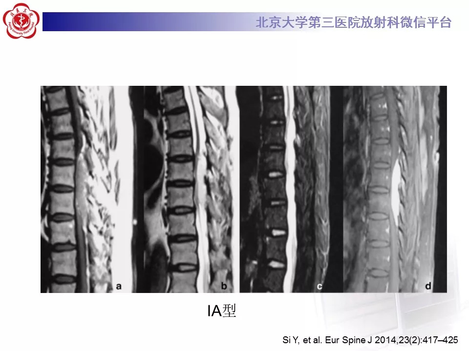 【病例】椎管内硬膜外血管脂肪瘤1例MR