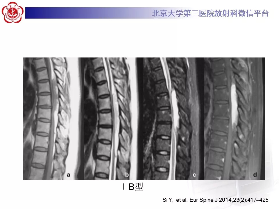 【病例】椎管内硬膜外血管脂肪瘤1例MR