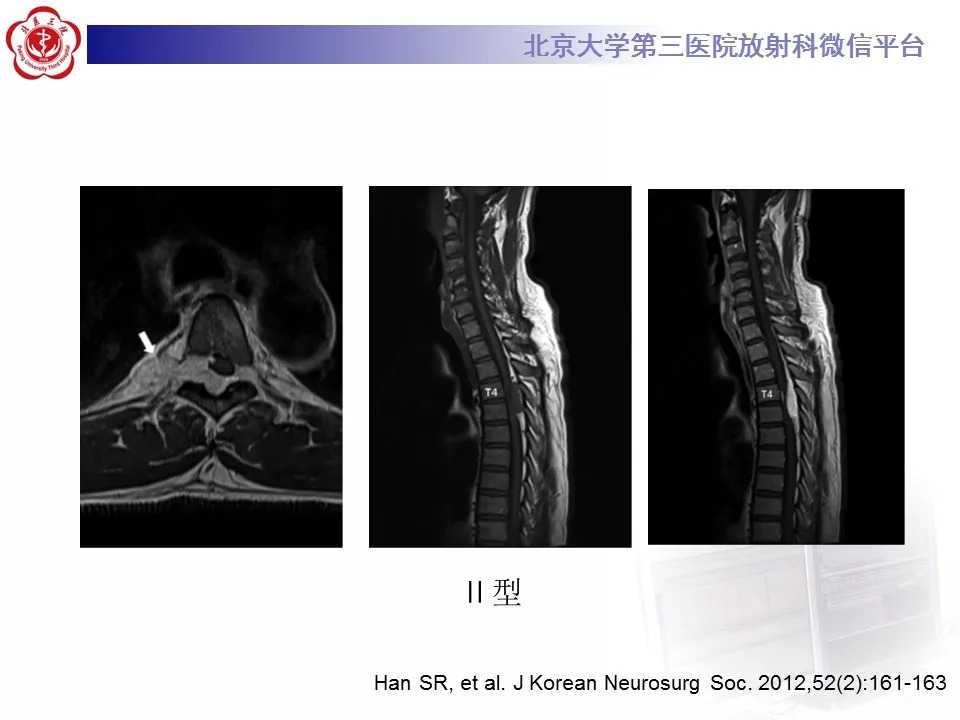 【病例】椎管内硬膜外血管脂肪瘤1例MR