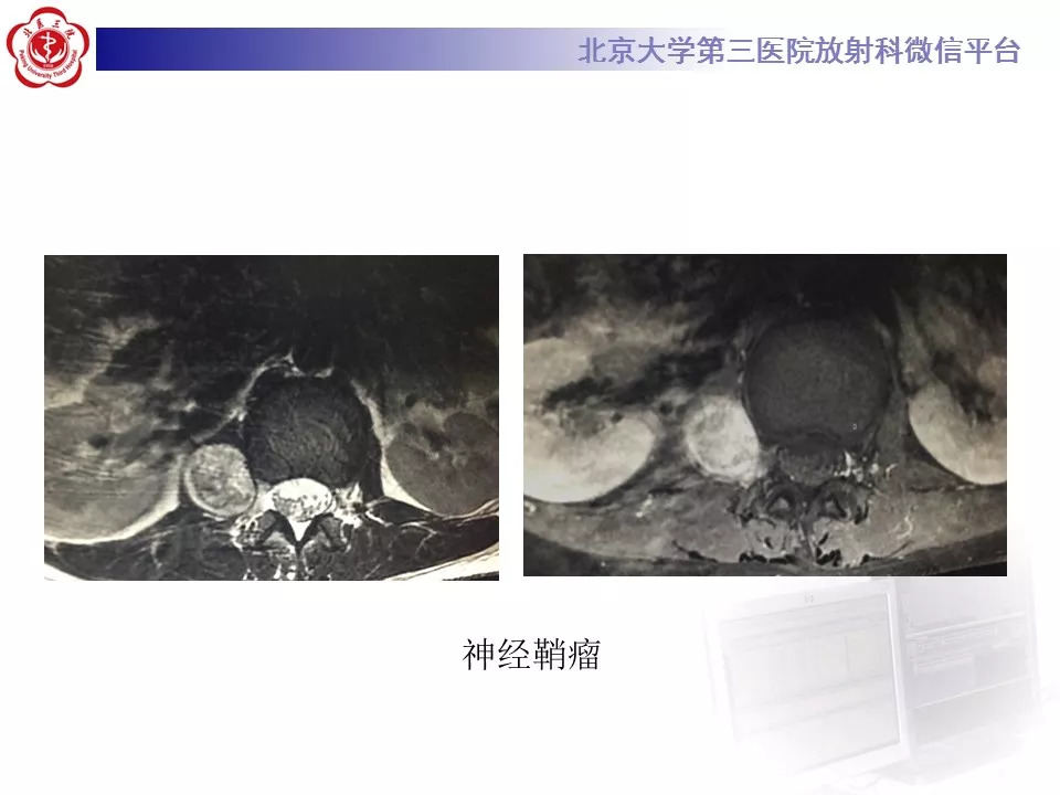 【病例】椎管内硬膜外血管脂肪瘤1例MR