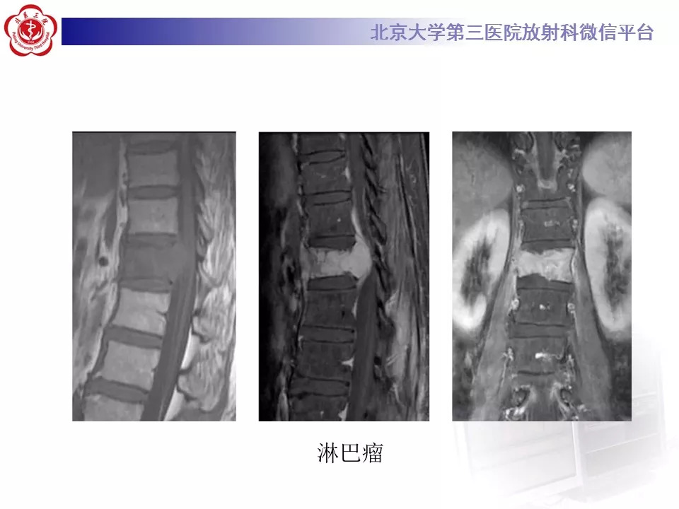 【病例】椎管内硬膜外血管脂肪瘤1例MR