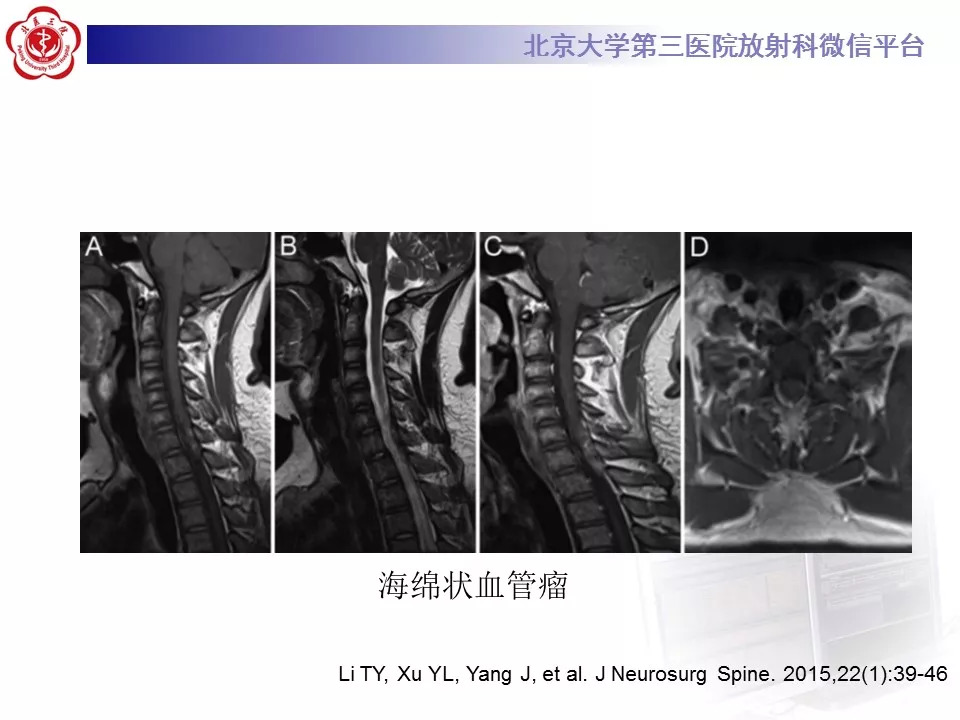 【病例】椎管内硬膜外血管脂肪瘤1例MR