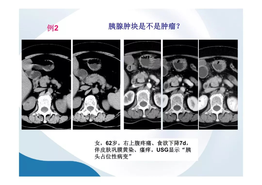 【PPT】胰腺非常见肿瘤影像学检查与诊断思路