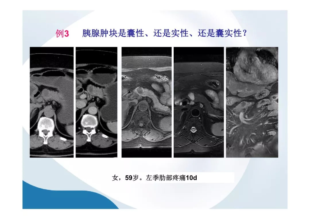 【PPT】胰腺非常见肿瘤影像学检查与诊断思路